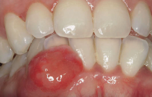 Dermatologie buccale